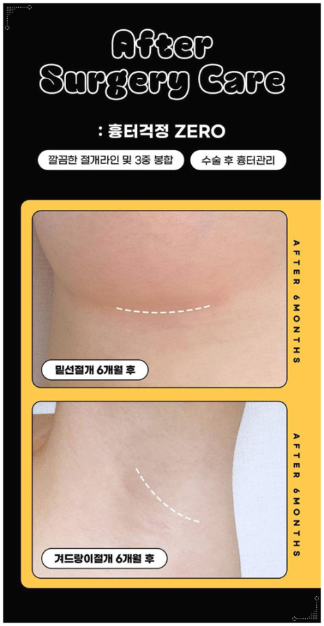 처진가슴 리프팅 수술, 출산후 수유후, 가슴 올리기, 보형물로 가능한가요? 관련 이미지 17