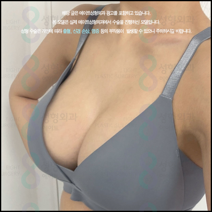 When Can You Exercise After Breast Augmentation, and How Long Is the Recovery Period? A Guide to Safe Recovery image 1