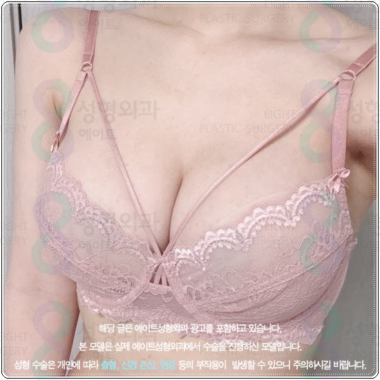 How Much Does Breast Augmentation with Mentor Xtra Cost? What to Know About Feel and Precautions Before and After Surgery image 1