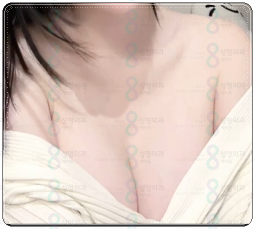 압구정성형외과유명한곳 가슴성형 시 알아봐야할 점은? 관련 이미지 5