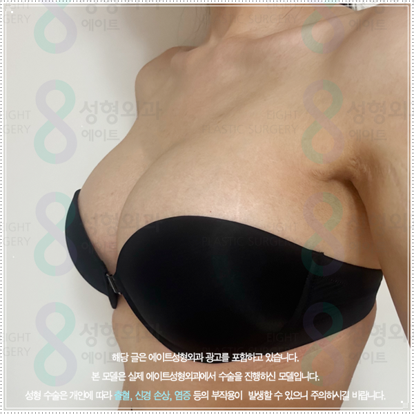 멘토 부스트 평균적인 가격, 작은 가슴 키우는 성형 방법과 수술 후 회복은? 관련 이미지 3