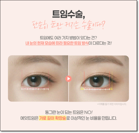 A Review of Upper Blepharoplasty Costs That Was Worth Every Penny! From How to Remove Mongolian Folds to Pricing and Recovery Care Tips image 9