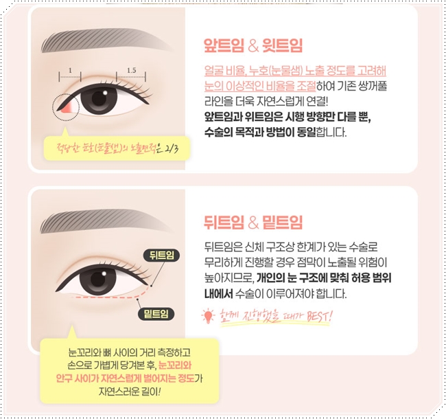 내 눈에 맞는 앞트임 필요할까? 수술 방법과 대략적인 비용 안내 관련 이미지 9
