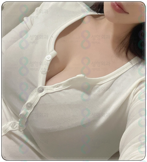 Motiva Breast Augmentation Review: What Are the Pros and Cons of the Implant? image 5