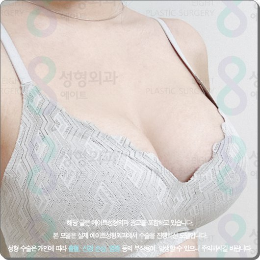 Where Should You Get Motiva Breast Augmentation? Costs and Surgery Tips from a Reputable Clinic image 3