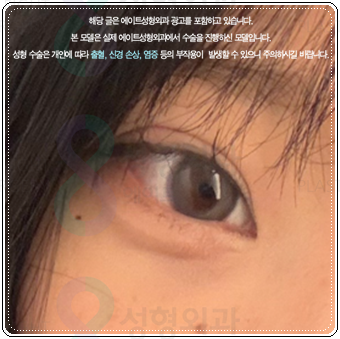자연유착 매몰, 절개 차이 비교해봐요. 풀림 걱정없이 눈성형 비용과 후기 참고하는법 관련 이미지 4