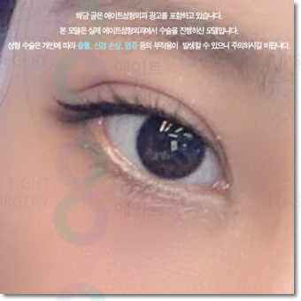 쌍수 가격은 평균적으로 얼마일까요? 매몰과 비절개? 절개 차이점까지 관련 이미지 4
