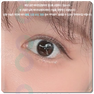 자연유착쌍커플 후기, 쌍수 할 때 재수술 없이 성공하려면? (비용 문의) 관련 이미지 3