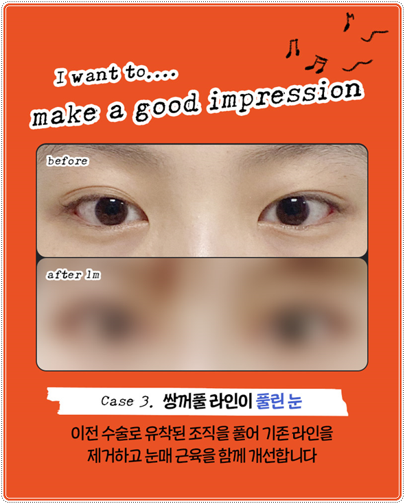 첫 쌍꺼풀 수술을 절개로 하고 눈 재수술은 매몰법(자연유착)으로 못하나? 비용 붓기는? 관련 이미지 13