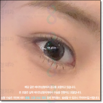 A Review of Upper Blepharoplasty Costs That Was Worth Every Penny! From How to Remove Mongolian Folds to Pricing and Recovery Care Tips image 5