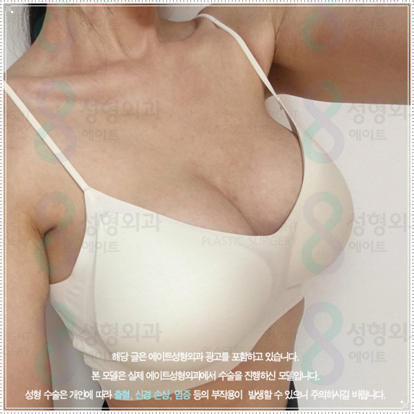 멘토 부스트 평균적인 가격, 작은 가슴 키우는 성형 방법과 수술 후 회복은? 관련 이미지 2