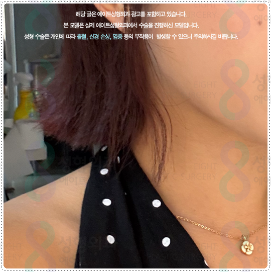 Ultherapy Lifting with 300 Shots: What Are the Price and Before-and-After Changes You Should Know Before the Procedure? image 2