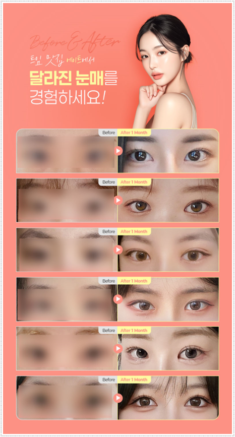 눈 앞트임과 윗트임 준비, 내돈내산 후기를 찾아볼 때 수술 전후 확인할 것 (비용 등) 관련 이미지 7