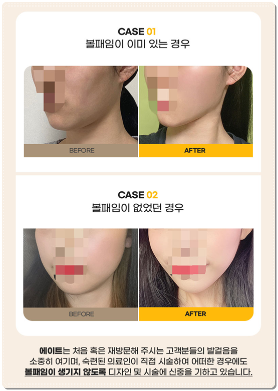 울쎄라 300샷 가격과 효과는? 100샷 후기&middot;전후 차이까지 비교 관련 이미지 12