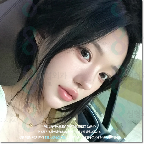 남자와 여자 차이? 매부리코는 수술 가격이 다를까요? 관련 이미지 4
