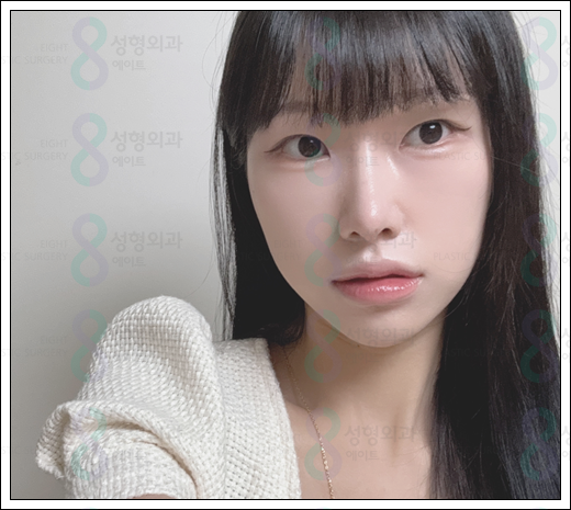매부리코 수술 비용 후기 정보 총정리 관련 이미지 6