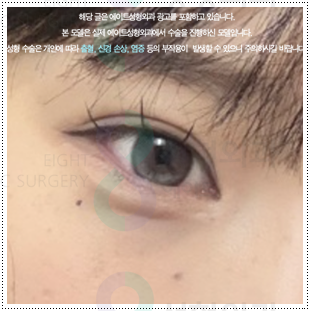 매몰쌍수와 앞트임 그리고 뒷트임, 밑트임까지 같이해도되나요? 관련 이미지 4