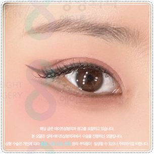 Suture or Incision? Which Double-Eyelid Design Looks Best? Understanding the Differences Between In-Out and In-Line Creases, Including the Semi-Out Line image 5
