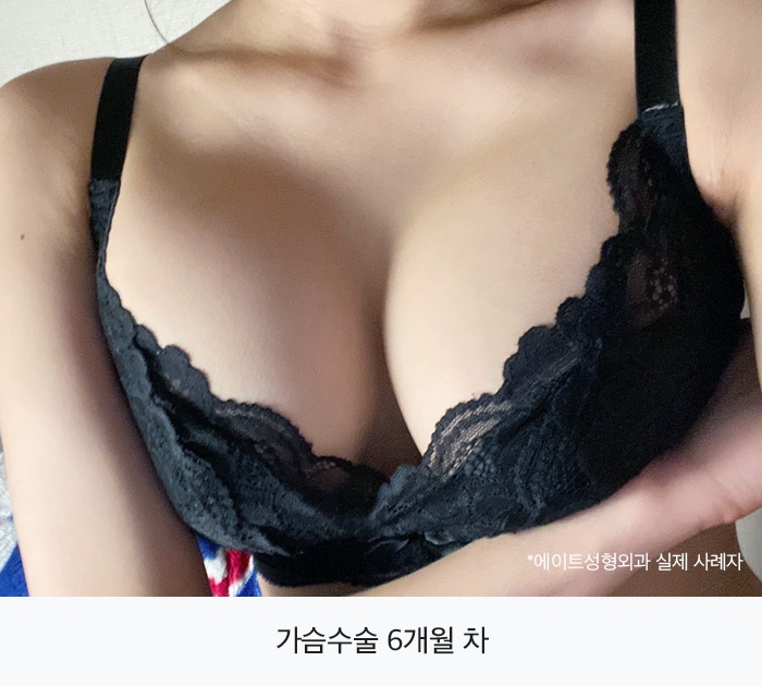 강남가슴수술 자신감까지 채우게 관련 이미지 5