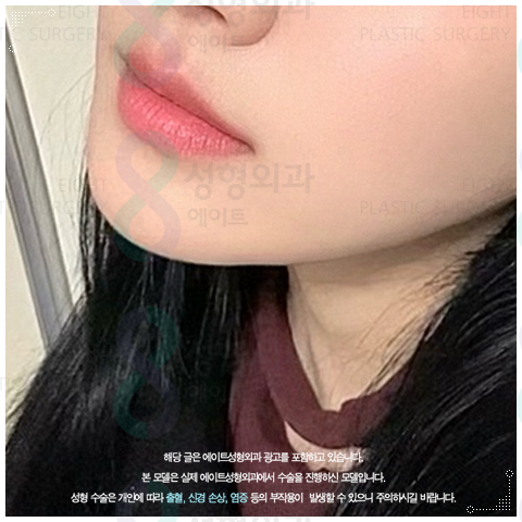 울쎄라 리프팅은 300샷으로 어느정도 효과가 있을까? 관련 이미지 5