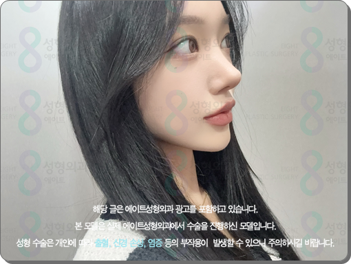 코수술 후기 일주일 1개월 비교? 평균 비용, 코성형 종류 장단점은? 관련 이미지 4