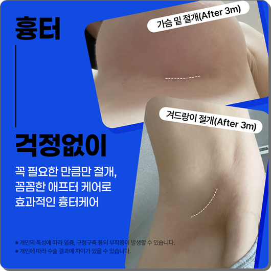 Where Should You Get Motiva Breast Augmentation? Costs and Surgery Tips from a Reputable Clinic image 7