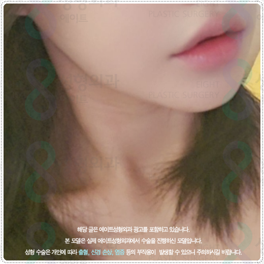 울쎄라 샷 수, 600샷과 300샷 차이점? 부작용 걱정과 가격 부담을 낮추려면 관련 이미지 4