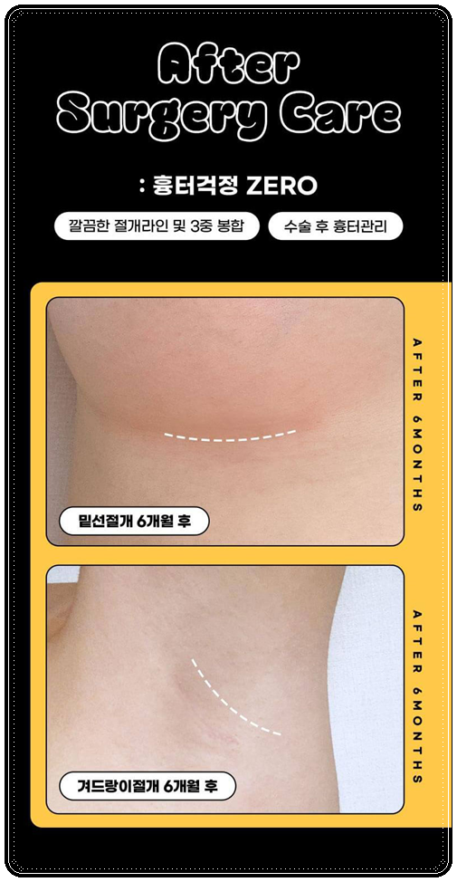 Motiva Breast Augmentation Review: What Are the Pros and Cons of the Implant? image 8
