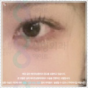 눈밑수술과 쌍꺼풀 같이해도될까? 눈밑지방재배치 쌍수 방법, 비용과 회복기간은? 관련 이미지 3
