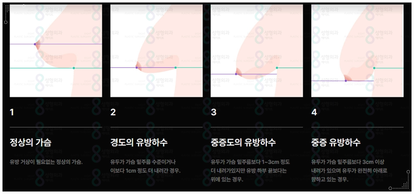 처진가슴 리프팅 수술, 출산후 수유후, 가슴 올리기, 보형물로 가능한가요? 관련 이미지 6