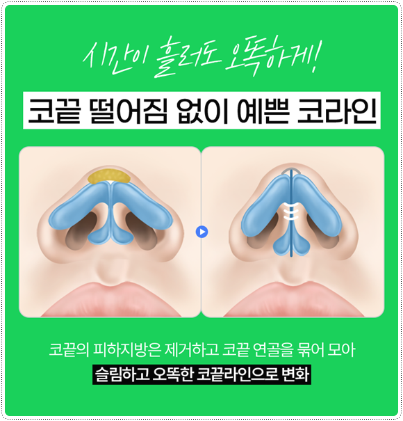 복코성형 콧볼축소 1개월 차! 코성형 붓기 빨리 빼는법과 코끝수술 후기 찾으셨나요? 관련 이미지 25