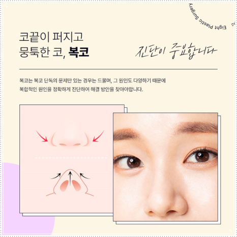 여자와 남자의 코성형 수술 차이점과 비용, 보형물 선택 가이드 관련 이미지 7
