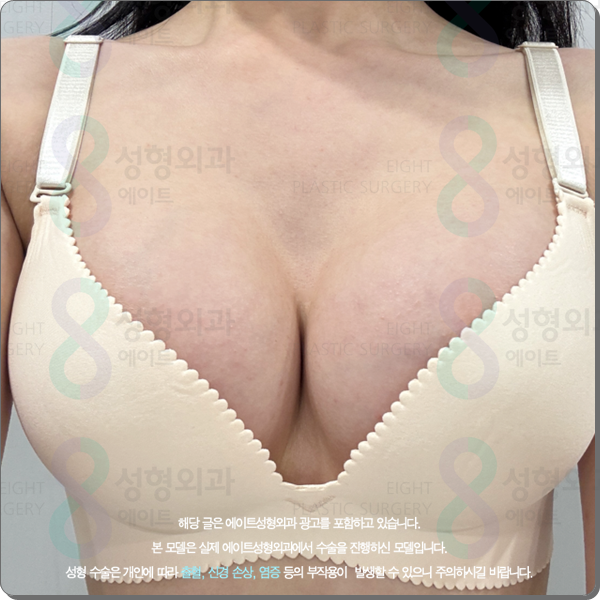 가슴확대 수술 어떤 보형물 종류로 해야 후기가 좋은가? (ps. 비용) 관련 이미지 4