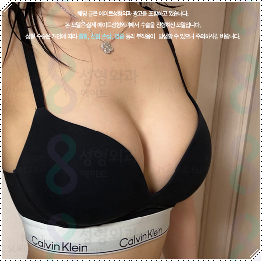 가슴성형으로 예쁜 가슴을 만들려면? 모티바 멘토 바운스 보형물에 대해 관련 이미지 1