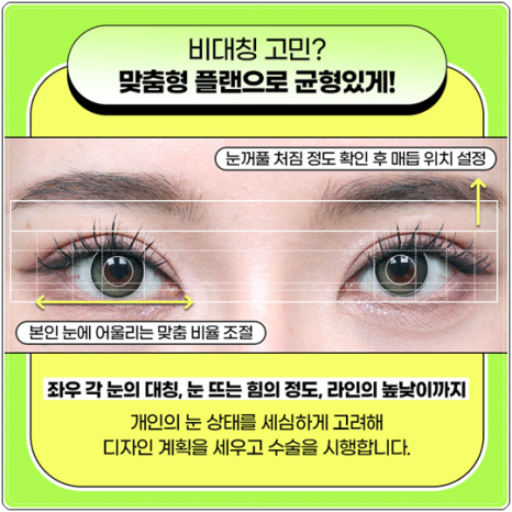 자연유착 매몰, 절개 차이 비교해봐요. 풀림 걱정없이 눈성형 비용과 후기 참고하는법 관련 이미지 12