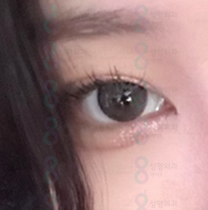 Hospitals That Are Good at Eye Plastic Surgery, Places That Are Good at Double Eyelid Surgery, Gangnam Places Good at Double Eyelid Surgery image 3