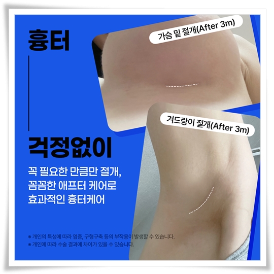 How much does breast augmentation surgery cost? image 5