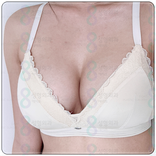 If You're Looking Into Breast Augmentation Cost Reviews, Be Sure to Read This image 6
