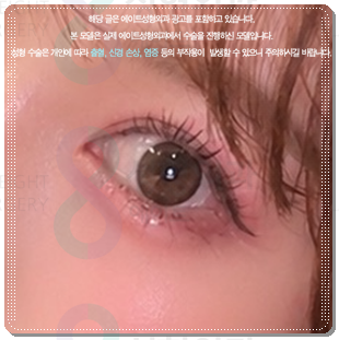 자연유착쌍커플 후기, 쌍수 할 때 재수술 없이 성공하려면? (비용 문의) 관련 이미지 2