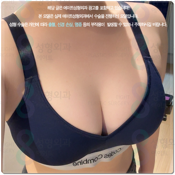 Are You Curious About the Cost of Breast Augmentation Surgery? Understanding the Differences Between Mentor Xtra and Smooth image 1