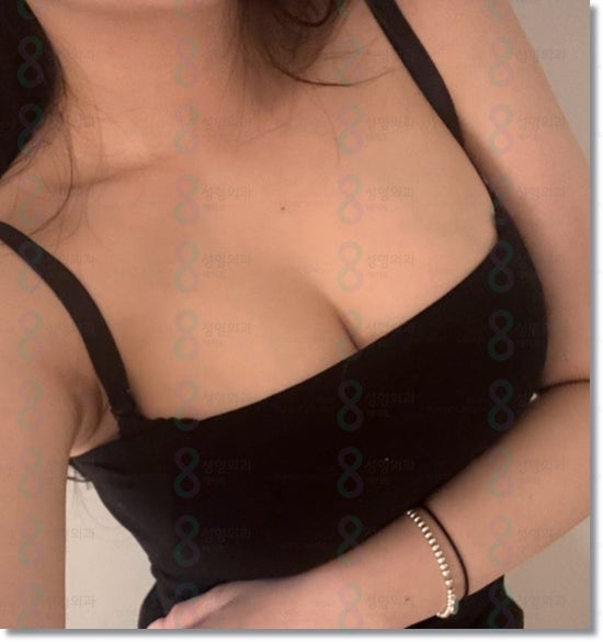 가슴보형물종류 모티바는 촉감이 정말 좋은가요? 관련 이미지 4