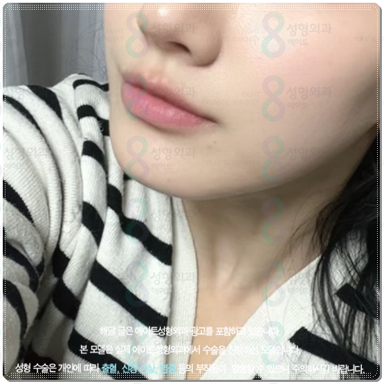 울쎄라 300샷 가격과 효과는? 100샷 후기&middot;전후 차이까지 비교 관련 이미지 3