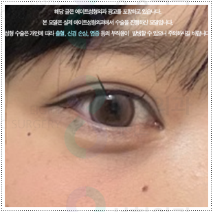 매몰쌍수와 앞트임 그리고 뒷트임, 밑트임까지 같이해도되나요? 관련 이미지 2