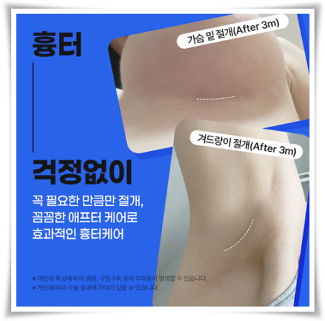 Best Places for Breast Augmentation: A Summary of Breast Implant Types, Pros, and Cons image 13