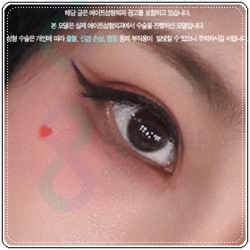 쌍꺼풀 아웃라인? 인라인? 수술 고민, 자연유착과 절개의 비용 차이는? 관련 이미지 2