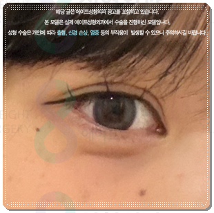 쌍꺼풀 라인을 다시 잡는 재수술, 매몰 방법과 비용은? 관련 이미지 4