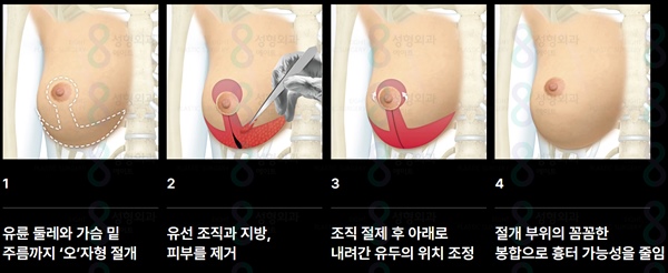 What Is the Difference Between Breast Ptosis Surgery and Breast Augmentation? image 11