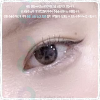 Natural Double Eyelid Surgery Using the Non-Incisional Method: A Budget and Consultation Guide for Middle School Students’ Eye Shapes Before and After Surgery image 4