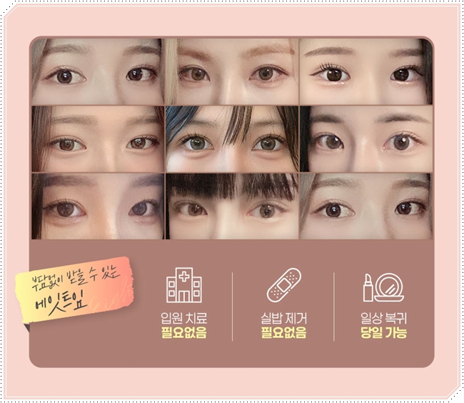 내 눈에 맞는 앞트임 필요할까? 수술 방법과 대략적인 비용 안내 관련 이미지 11