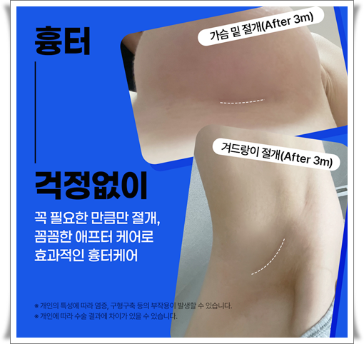 Breast Augmentation Surgery Cost Based on Mentor Implants image 8